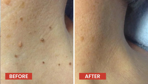 Derma Smooth Skin Tag Removal PatchDERMA SMOOTH SKIN TAG REMOVAL PATCH
