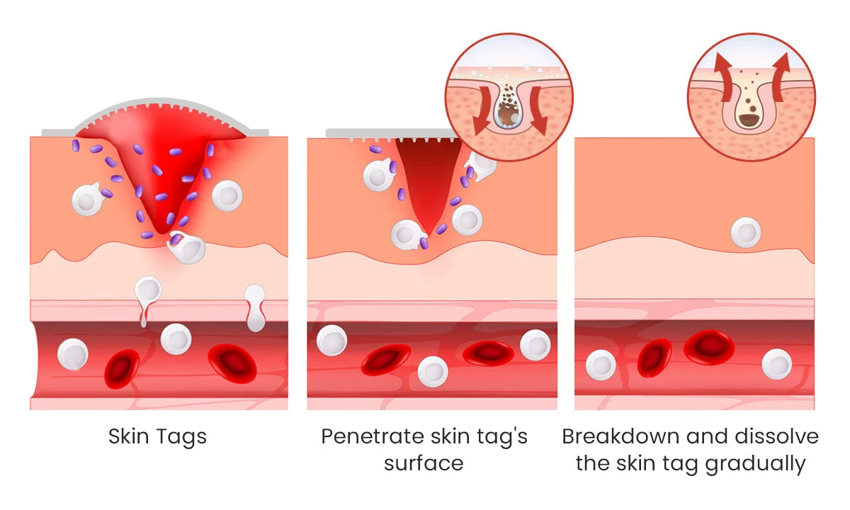 Derma Smooth Skin Tag Removal PatchDERMA SMOOTH SKIN TAG REMOVAL PATCH