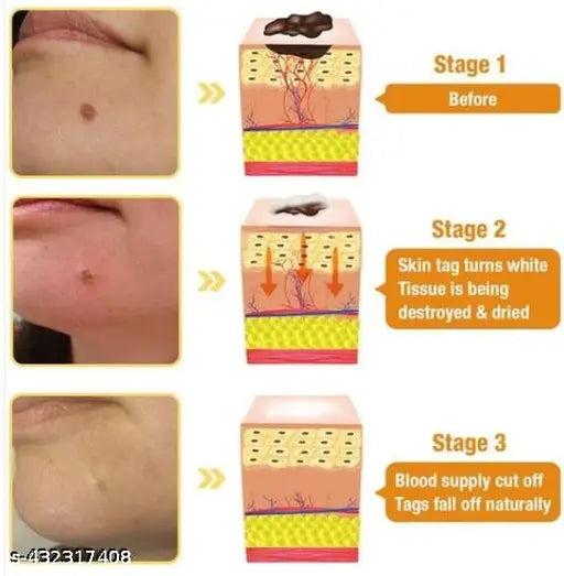 Derma Smooth Skin Tag Removal PatchDERMA SMOOTH SKIN TAG REMOVAL PATCH