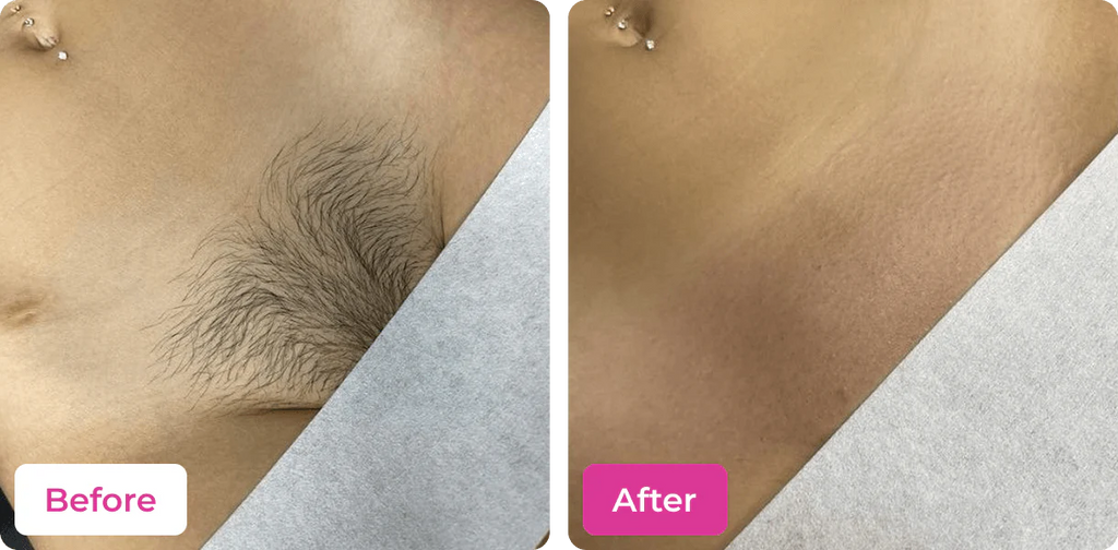 RATED 4.6/5  🚫🪒 4-in-1 Bikini Hair Removal Wax Powder Mask ✨🌸
