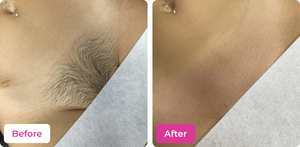 RATED 4.6/5  🚫🪒 4-in-1 Bikini Hair Removal Wax Powder Mask ✨🌸