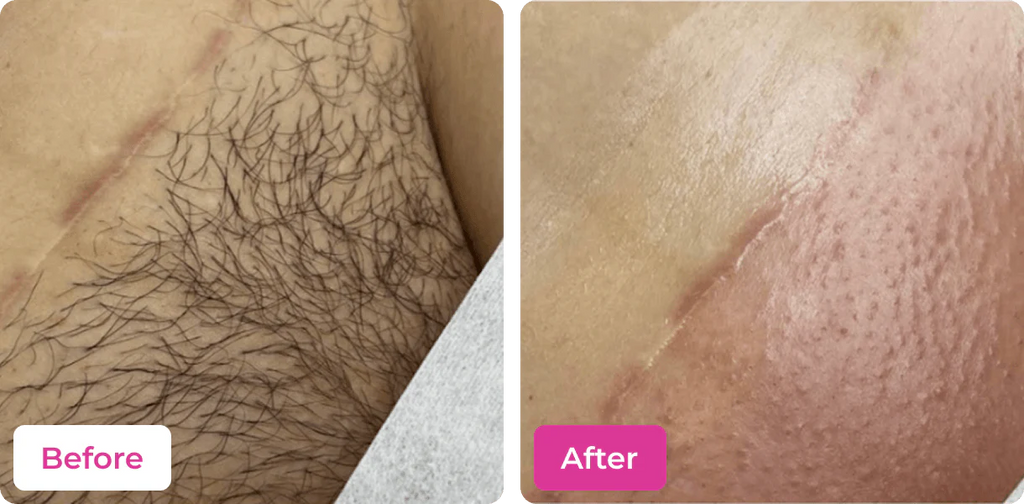 RATED 4.6/5  🚫🪒 4-in-1 Bikini Hair Removal Wax Powder Mask ✨🌸