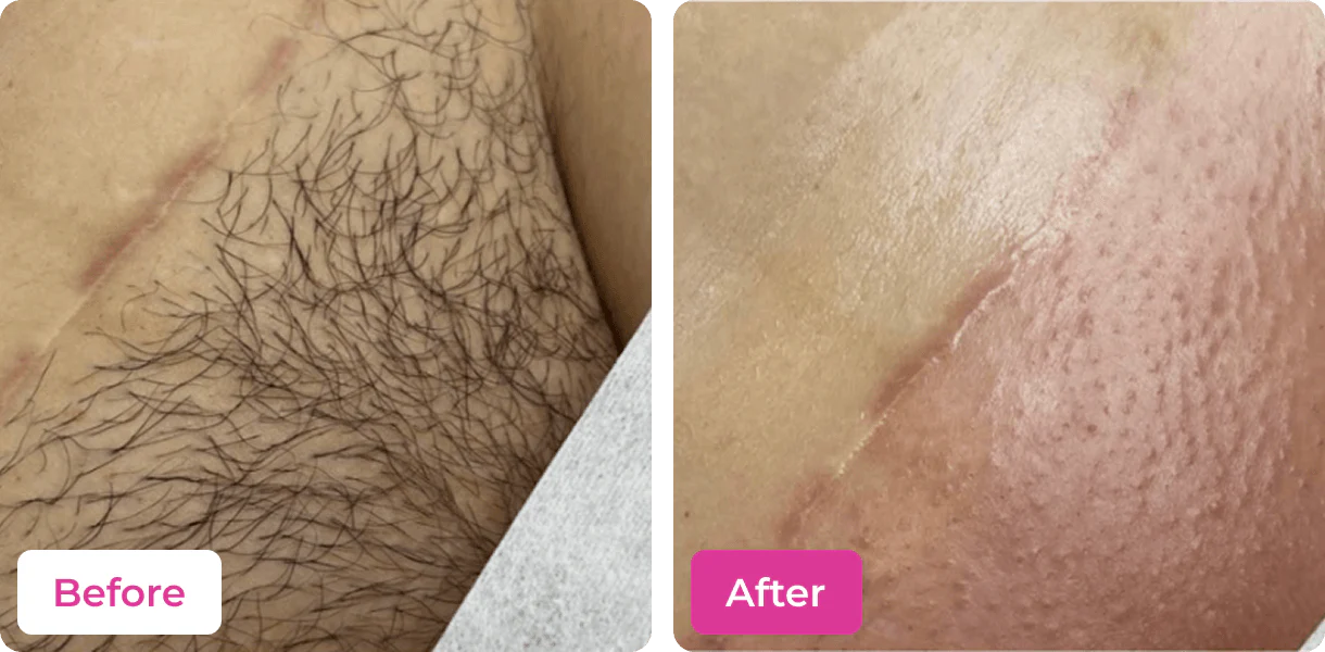 RATED 4.6/5  🚫🪒 4-in-1 Bikini Hair Removal Wax Powder Mask ✨🌸
